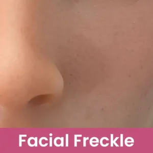 Facial Freckle