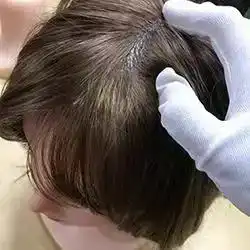 Synthetic Hair Implants (FREE)